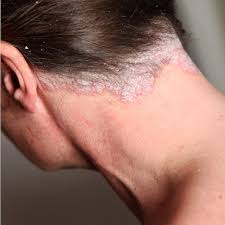 Image result for seborrheic dermatitis