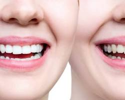 Image of person with chipped teeth before and after receiving veneers