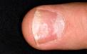 Nail abnormalities - NHS Choices