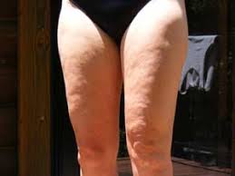 Image Results for "images of people hurt have cellulite"