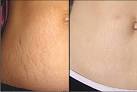 Stretch mark makeup cover