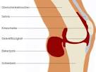 Bakerzyste. Schwellung in Knie Kniekehle Wissen Patient