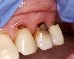 Image of Root Caries