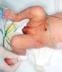 Image result for newborn diaper rash