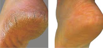 TOPUK ÇATLAĞI ile ilgili görsel sonucu