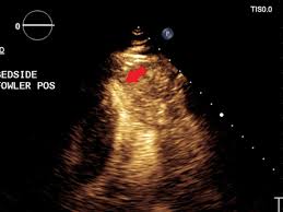 Revealing Apical Hypertrophic Cardiomyopathy in a 91-Year-Old Patient