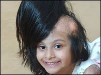 Doctors helped Sidra Afzal grow her hair again after a burns accident - _43040633_sidra203