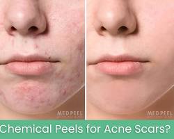 Image of acne scars before and after chemical peel