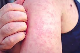 South Carolina reports 99 new measles cases; now more than 300 cases in Upstate outbreak