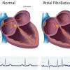 Imagen de la noticia para fibrillation de AAFP News