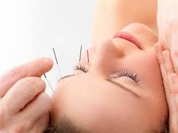Resultado de imagen para fotos de acupuntura facial