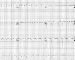 Image of Flutter atrial EKG