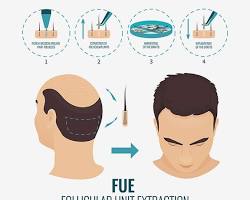 FUE eyebrow transplant hair follicle extraction resmi