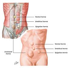 Hasil gambar untuk Hernia irreponibilis