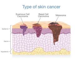 Image of Melanoma skin cancer