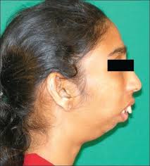 Image result for micrognathia