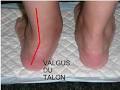 manires de corriger des pieds plats - How