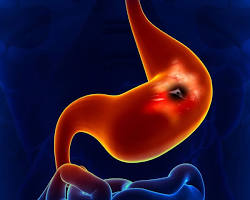 Mide ülseri ameliyatı resmi