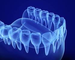 Image of 3D dental scan