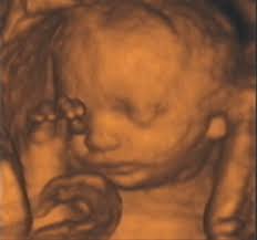 Figure 13, a 3-D ultrasound image of a fetus rubbing its eye with its hand and the umbilical cord in front of its mouth. Image courtesy of Stefano Ciatti, ... - 2003_12_30_14_26_07_706