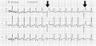 Cours: Palpitations et troubles du rythme - Besancon-cardio. org
