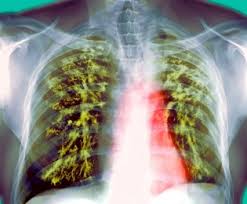 Resultado de imagen de tuberculosis extrapulmonar