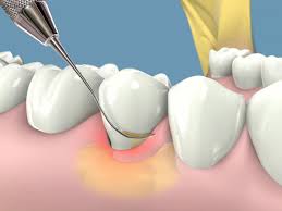 Resultado de imagen para DEFINICION DE ENFERMEDAD PERIODONTAL y tratamiento