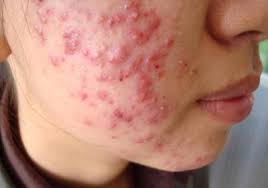 Kết quả hình ảnh cho mụn đầu trắng