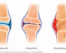 Arthritis Symptoms and Treatment