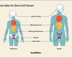 Image of Germ cell tumors