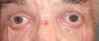 Resultado de imagen para ectropion cicatrizar