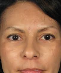 As you can see, she is quite youthful and takes great care of her face and skin. But she has unwanted skin folds along the lower eyelid that distract from ... - BlogBleph49FrontalBefore