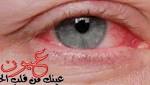تعرف على أكثر أمراض العيون