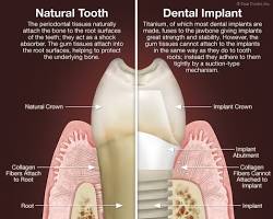 Image of comparison between a natural tooth and a dental implant