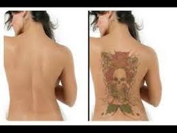 លទ្ធផល​រូបភាព​សម្រាប់ tattoo removal