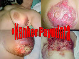 Image result for kanker
