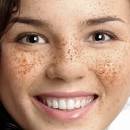 What Are Freckles? - KidsHealth