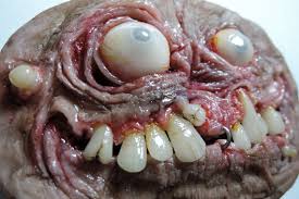 Image result for teratoma