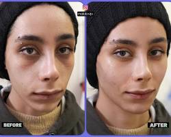 تصویر فیلر زیر چشم