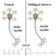 32. Multippel sklerose