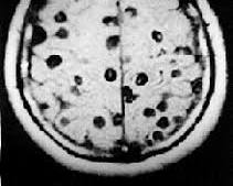 Imagem de Cisticercose no cérebro