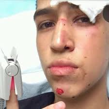 Courtesy Jonathan Gutierrez. 56 days. College Tour Tragedy. 15 of 45. California Bus Crash: Survivor Snapchats From Hospital Bed. - 140411-ngee-bus-crash-530a_8734f1fd1339ebcb3a954e0b547b2ed5