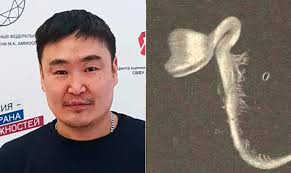 Plant seed found growing in Russian man's eye after branch strike