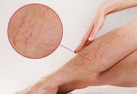 6 dấu hiệu cảnh báo suy giãn tĩnh mạch chân - Báo Nam Định ...