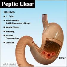 Image result for ulcer