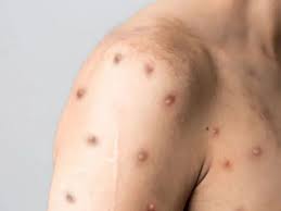 Governo de MG confirma três casos de Mpox, na Grande BH