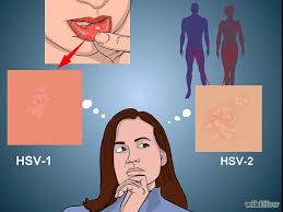 Resultado de imagen para herpes