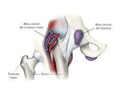 Imagen de Bursitis de cadera