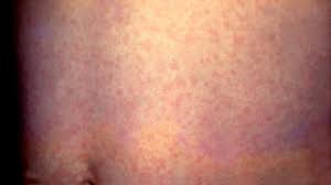 Image result for measles