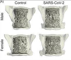 Inflammation Resulting from COVID-19 Increases Fracture Risk and Bone Loss - 1